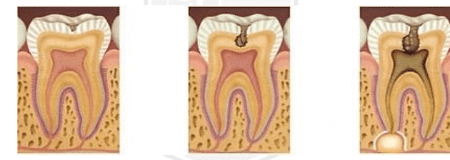 Imagem de progressão da cárie dental