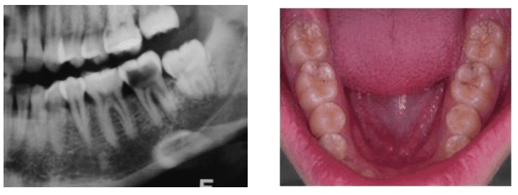 Radiografia e foto de cárie em paciente