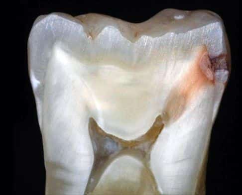 Dente natural com visãod e cárie através de um corte no meio.