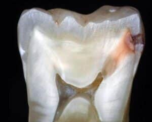 Dente natural com visãod e cárie através de um corte no meio.